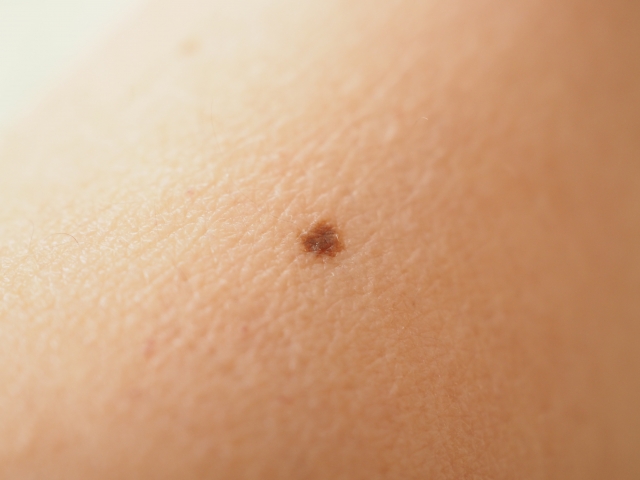 肌にあるほくろの写真