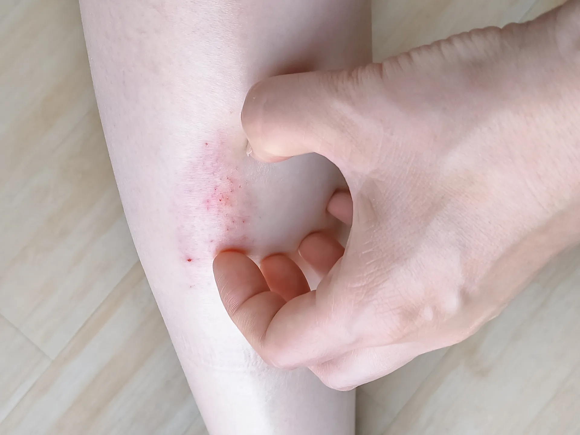 あせもが腕にでき、搔いている様子の画像