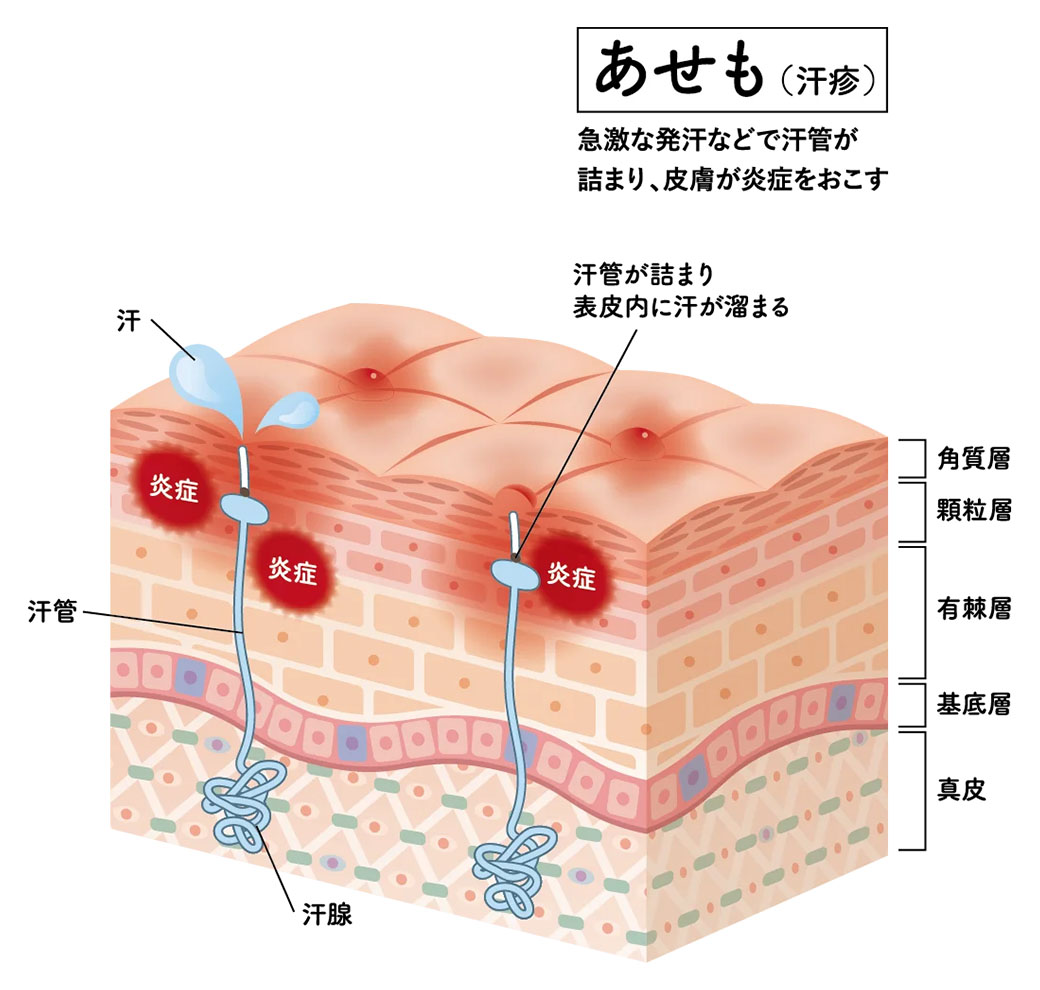 あせもの原因を表した皮膚断面図