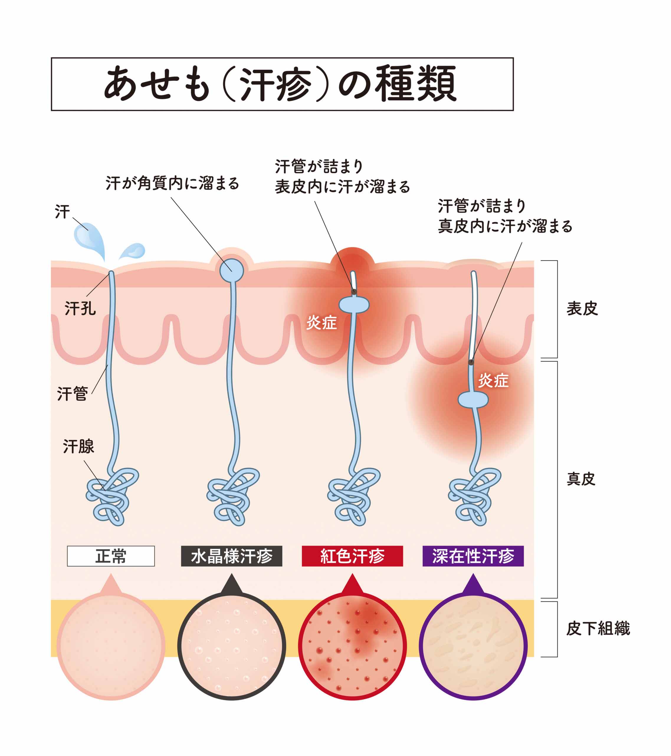 あせもの種類を比較した皮膚断面図