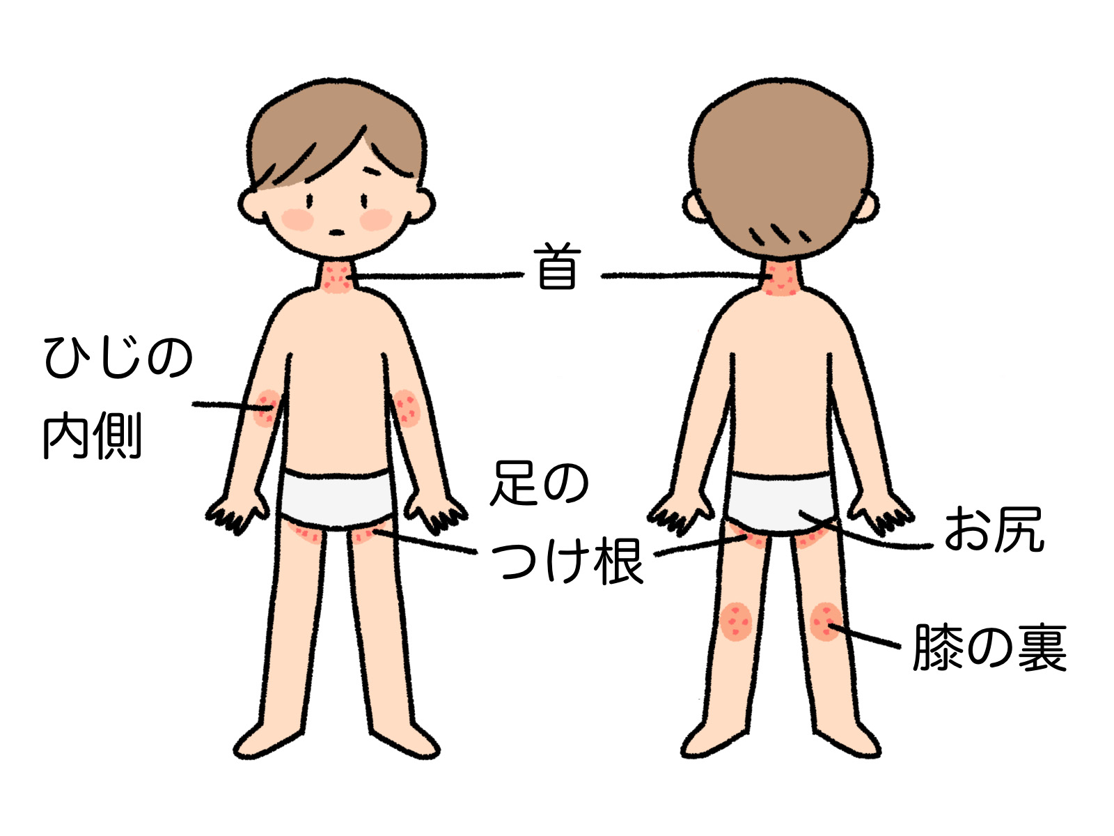 あせもが出来やすい部位