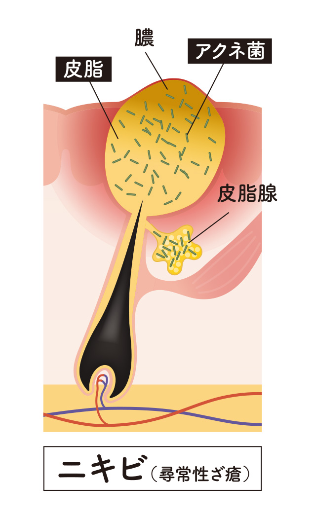 毛穴に皮脂がつまりアクネ菌が増殖している皮膚断面図