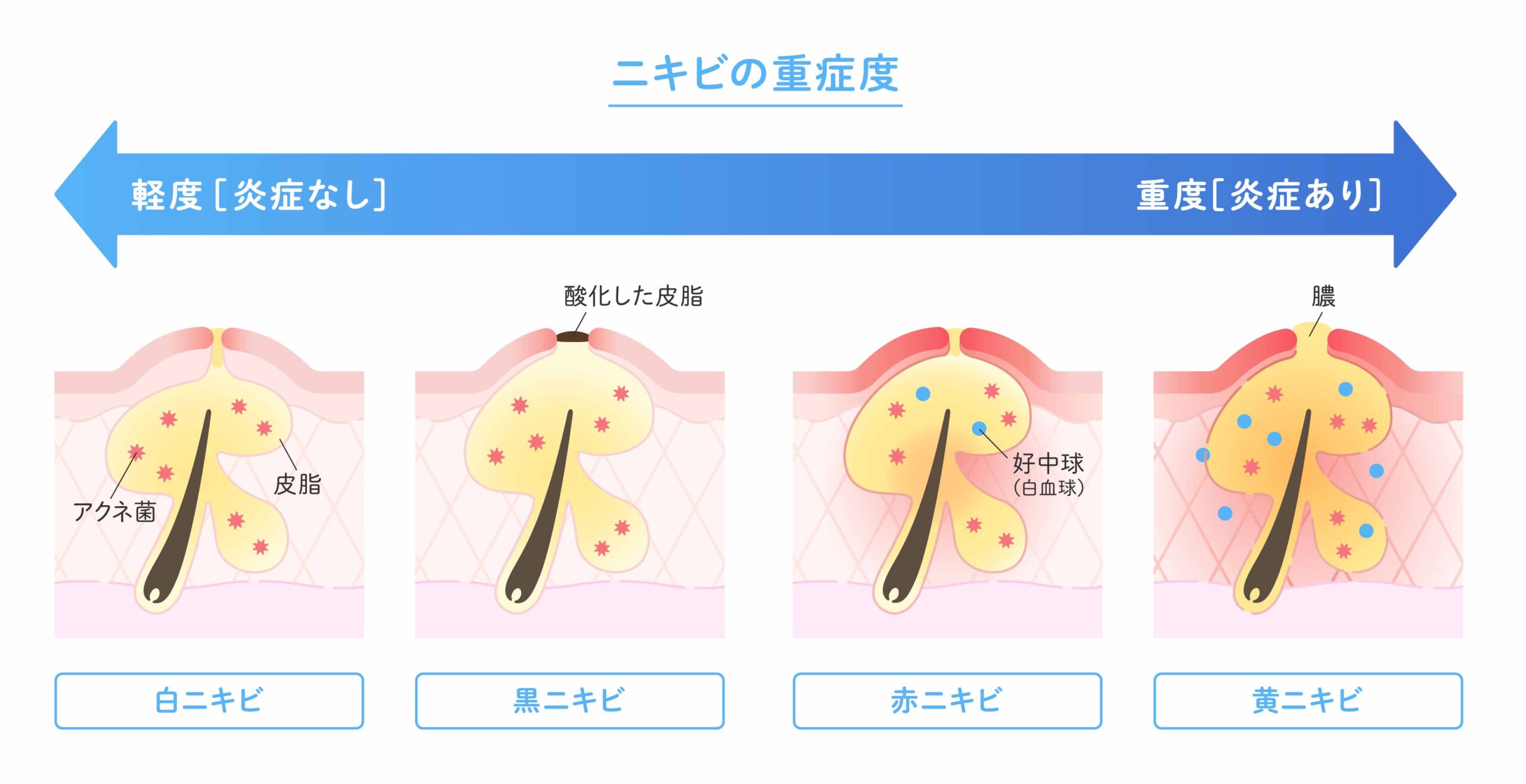 白ニキビから黒ニキビ、赤ニキビ、黄ニキビまでの重症度