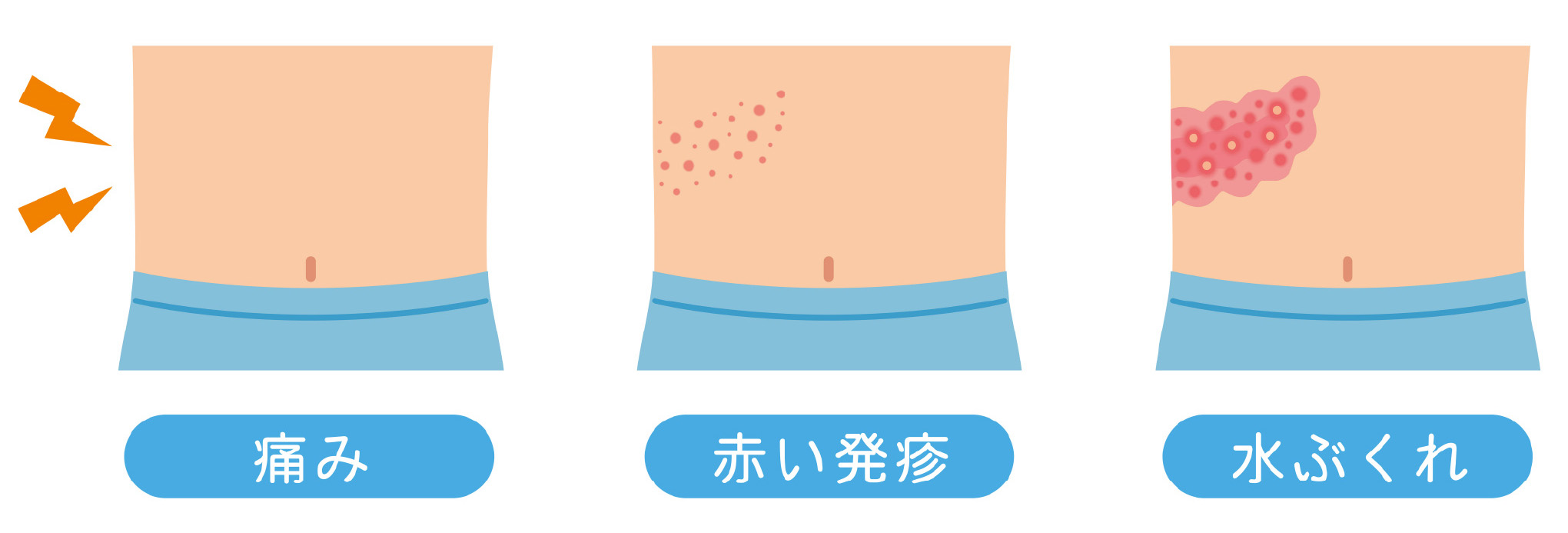 帯状疱疹の痛みや赤い発疹、水ぶくれがわき腹に広がる様子