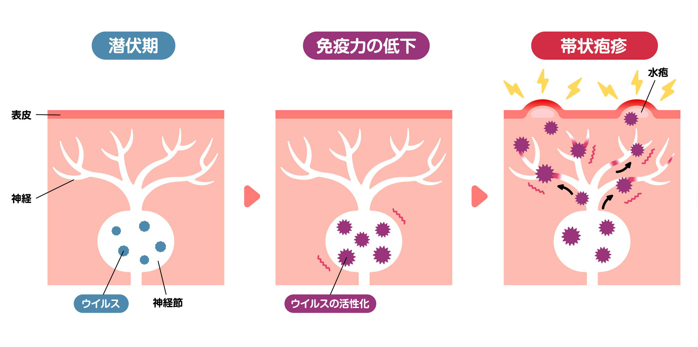帯状疱疹の潜伏期間から免疫の低下、帯状疱疹発症までの流れ