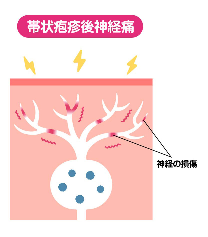 帯状疱疹後神経痛が起こる様子