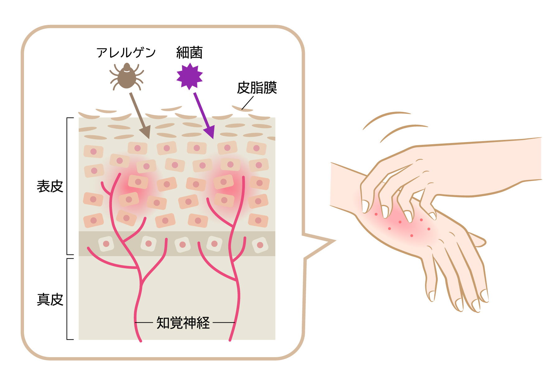 手湿疹がアレルゲンや細菌によって引き起こされるメカニズム