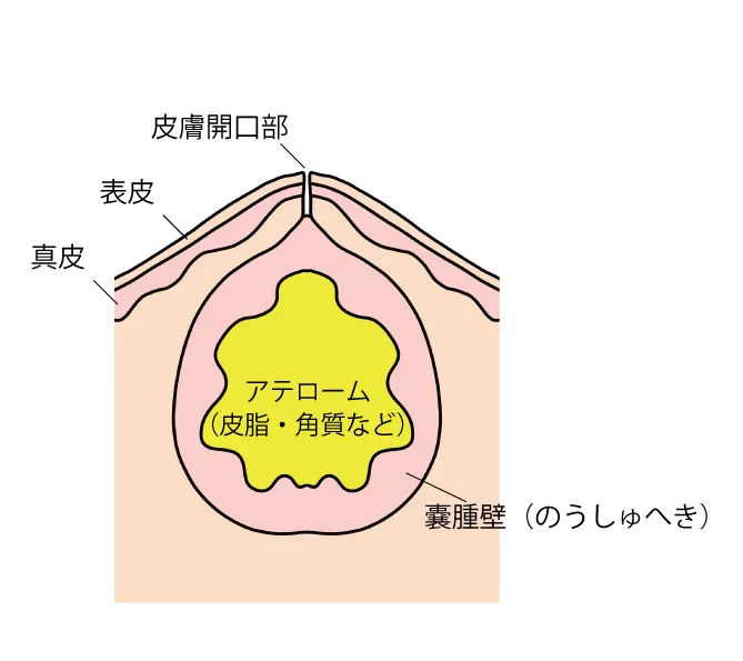粉瘤（アテローム）の内部構造。皮膚の下に袋（嚢腫壁）があり、中に皮脂や角質が溜まっている様子を示すイラスト