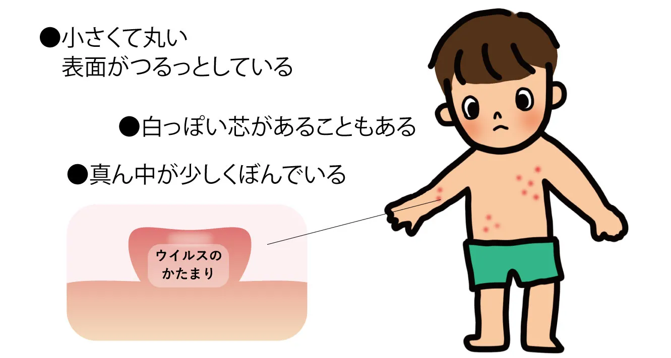 水いぼの構造図解：皮膚の表面が盛り上がり、中央が少し凹んでいる。内部にはウイルスの塊（軟属腫小体）が含まれている様子