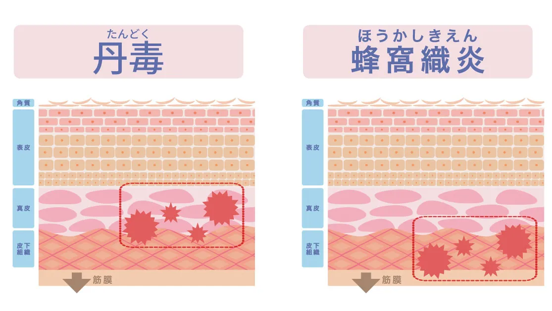 丹毒と蜂窩織炎の炎症の深さの比較図