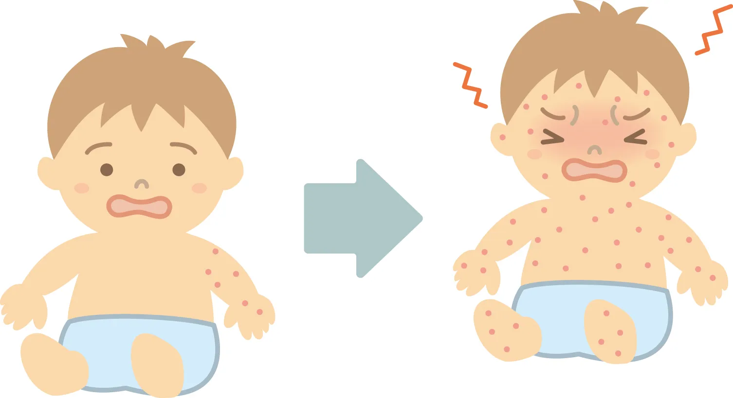 赤ちゃんが体をかきむしり、赤いぶつぶつが全身に広がっていくイラスト