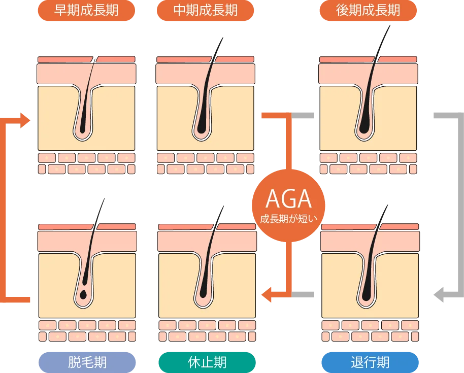 AGAにより毛が十分に育たなくなる仕組みの図