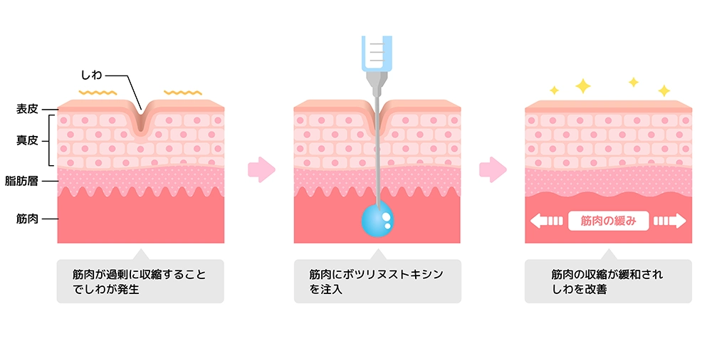 ボトックスの仕組み