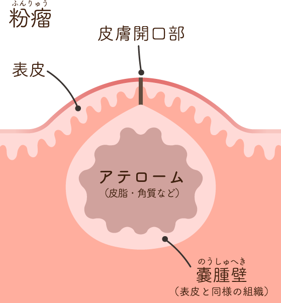 くりぬき法による施術の手術手順