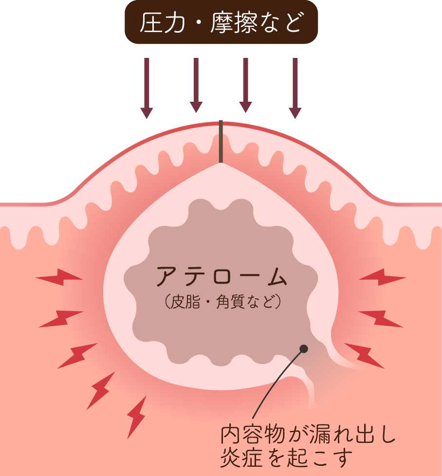 炎症性粉瘤の皮膚断面図