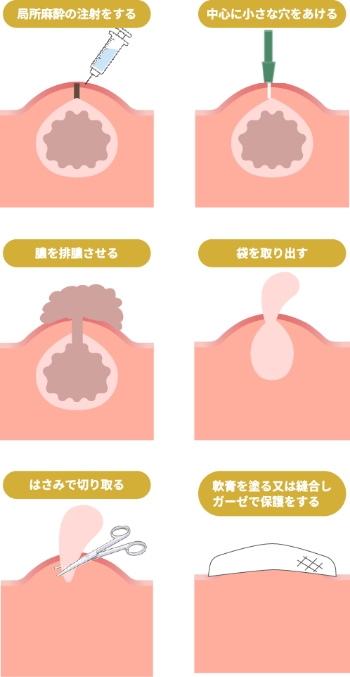 くりぬき法による施術の手術手順