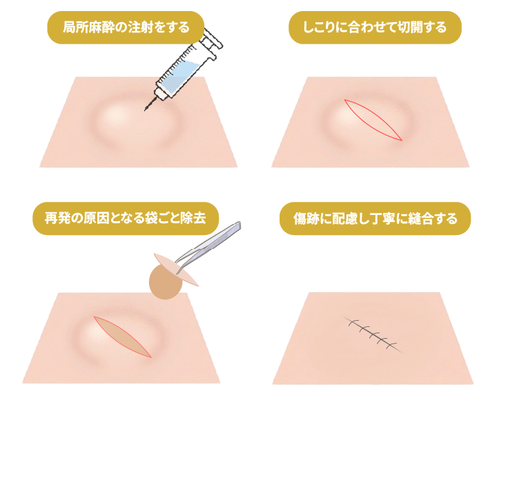 切開法による施術の手術手順