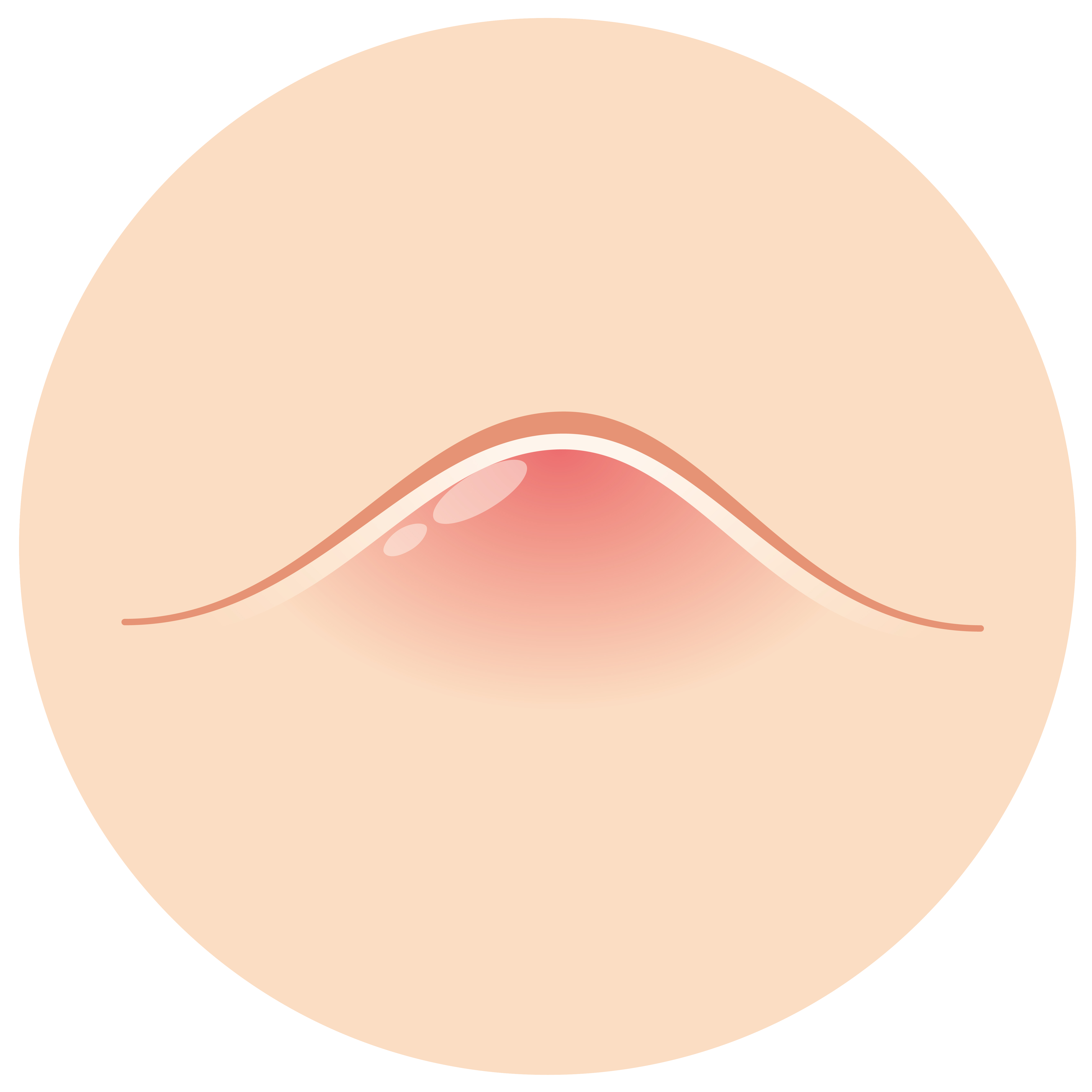皮膚にできた粉瘤のイラスト