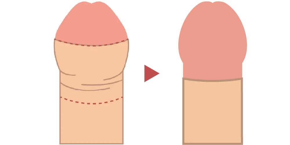 環状切開術のイメージイラスト