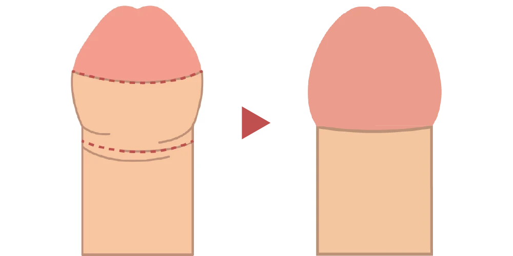 亀頭直下切除術のイメージイラスト