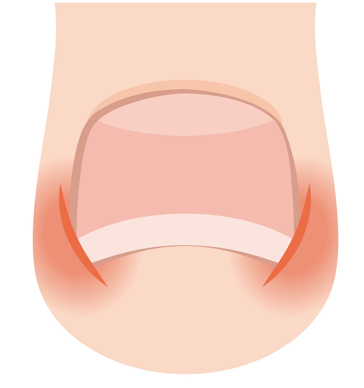 陥入爪のイメージイラスト
