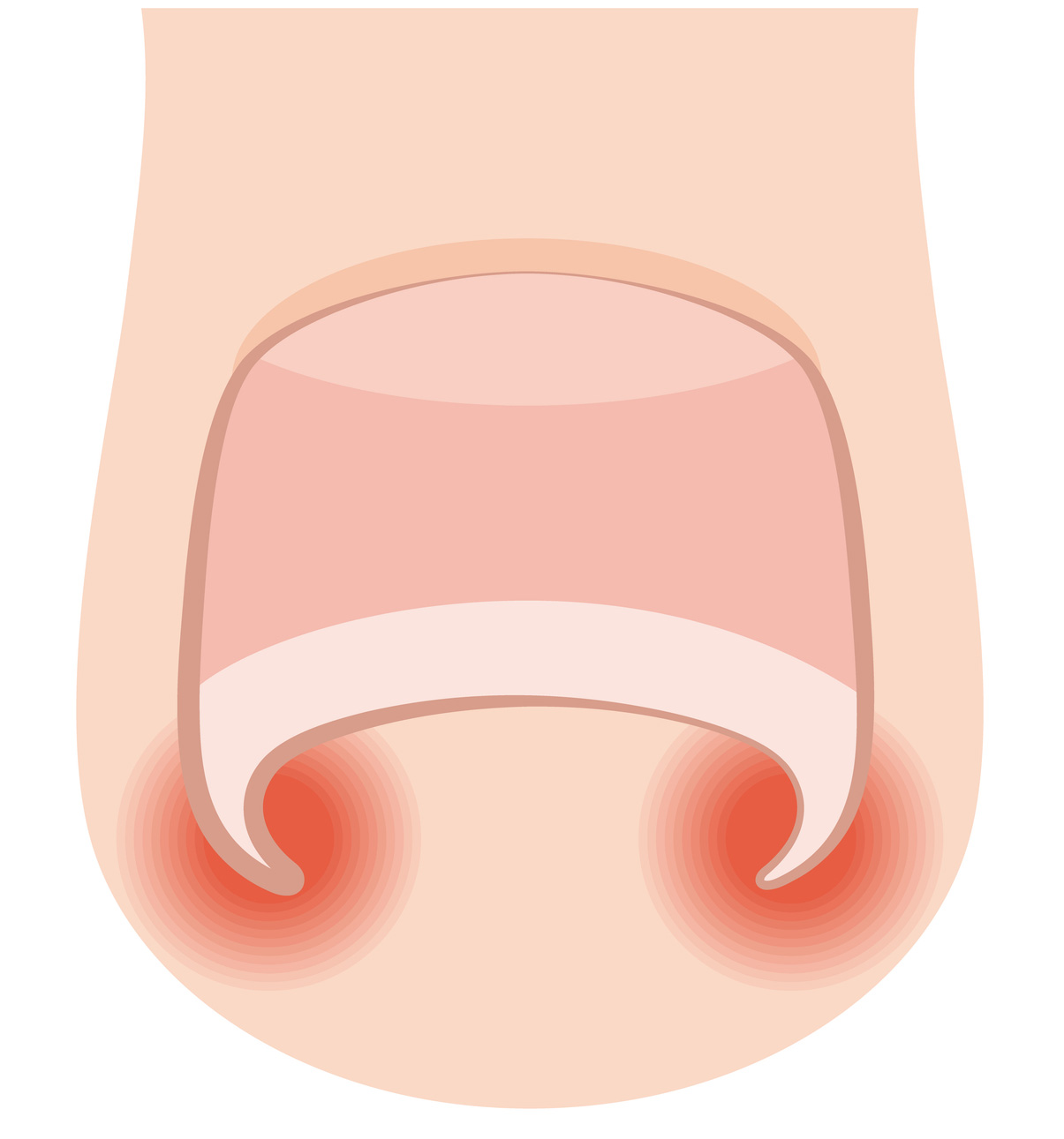 巻き爪のイメージイラスト