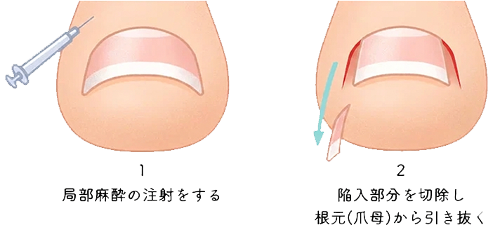 フェノール法による手術の手順のイメージイラスト