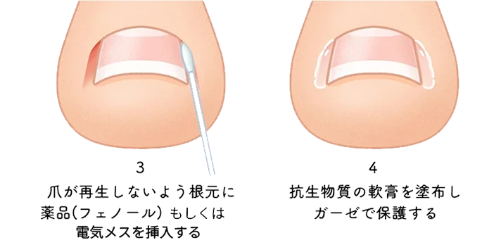 フェノール法による手術の手順のイメージイラスト
