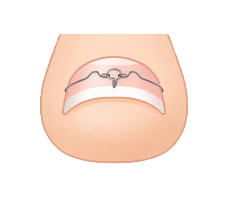 コレクティオパーフェクトのワイヤー矯正の装着イメージイラスト