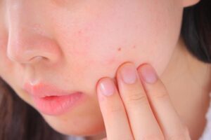 Close-up of a person touching their cheek, highlighting small red pimples and smooth skin surrounding them.