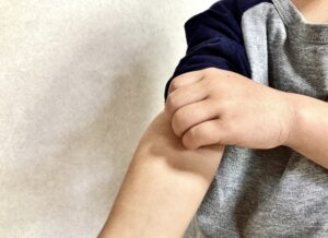 小児が腕を掻いている写真
