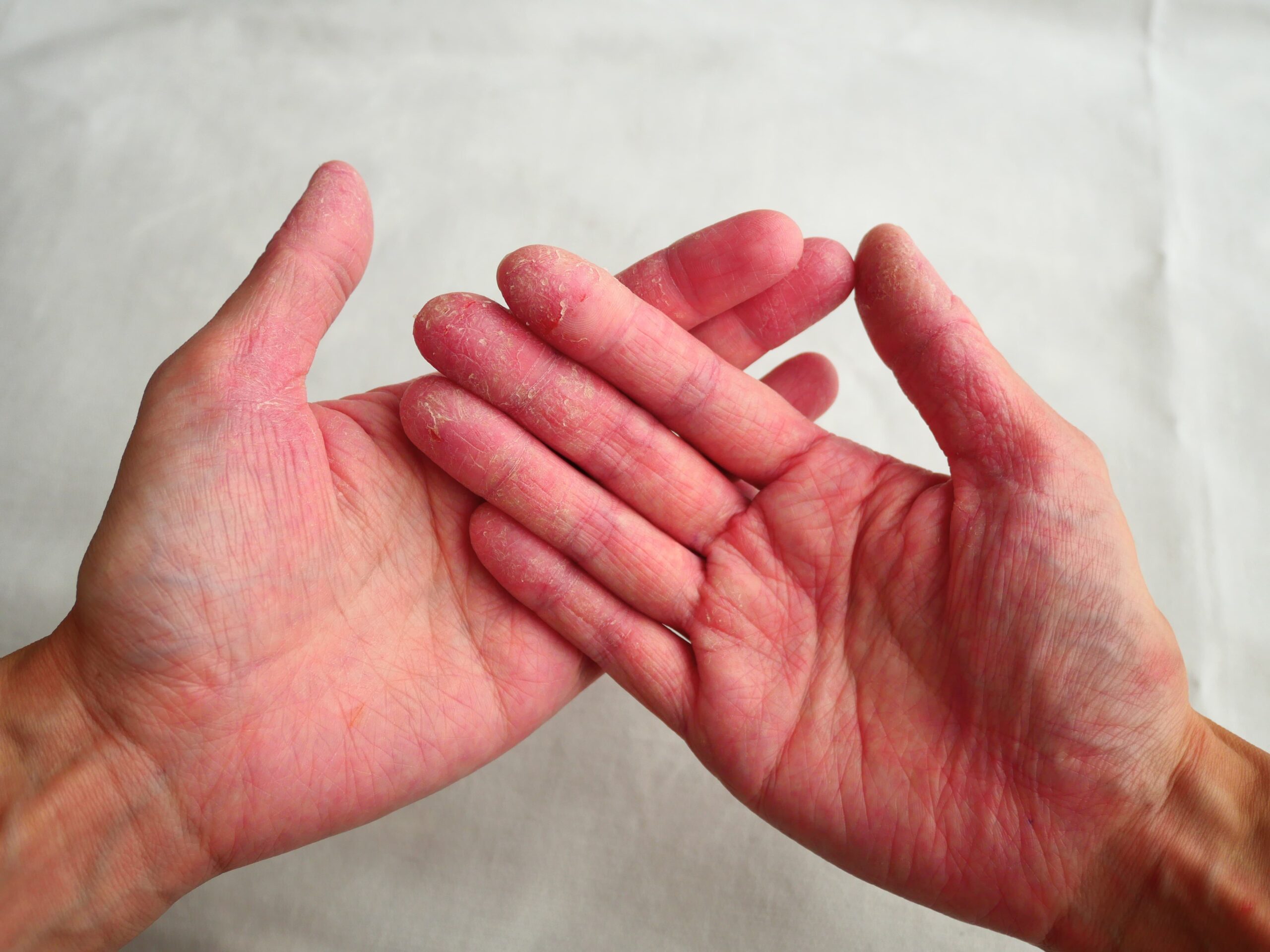 手湿疹のイメージ画像