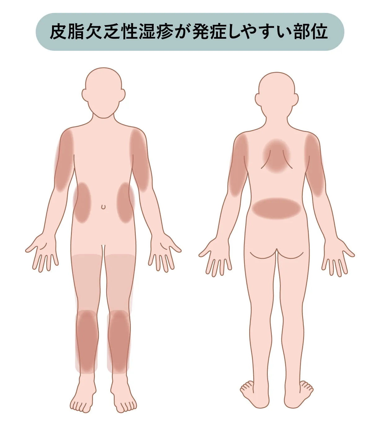 皮脂欠乏性湿疹を発症しやすい部位の図解：腕から肩、わき腹、太もも、すね、背中、腰が赤く示されている全身イラスト