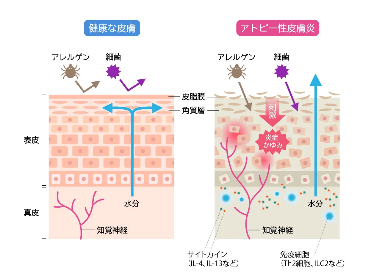 正常な肌とアトピー肌の比較｜小児アトピー性皮膚炎のバリア機能解説図