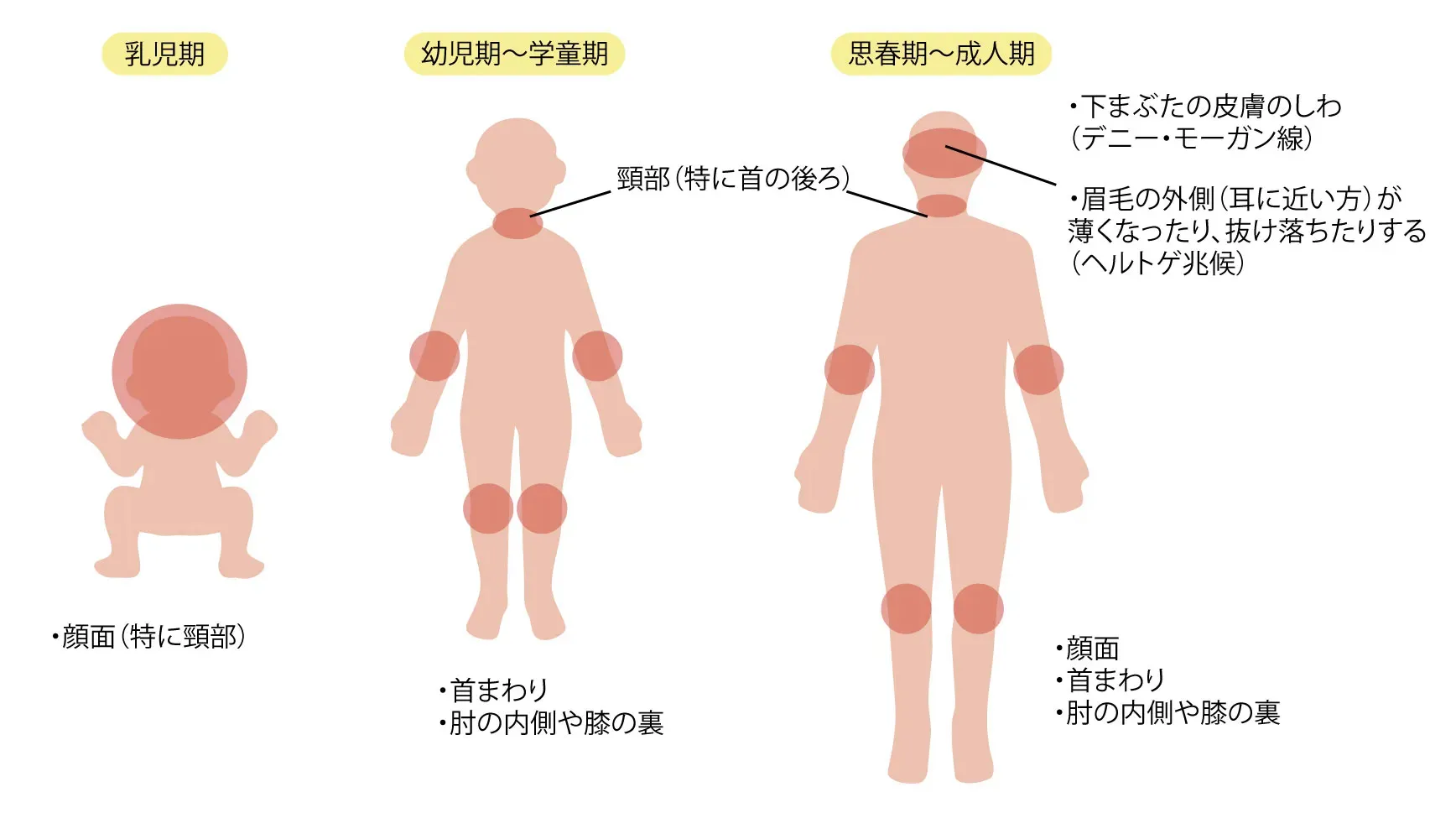 アトピー性皮膚炎の年齢別・部位別の特徴：乳児期の顔面湿疹、学童期の肘や膝の裏、成人のデニーモーガン線やヘルトゲ兆候の図解