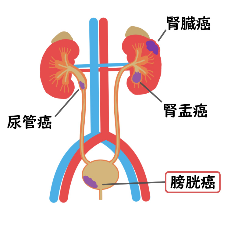膀胱がんやその他泌尿器系の癌のできる部位