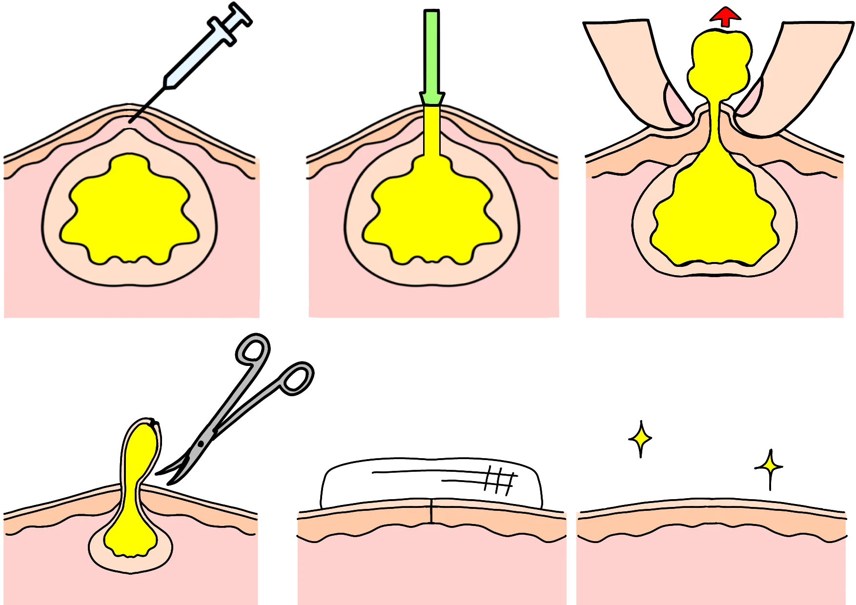 粉瘤（アテローム）の手術手順イラスト：切開して内容物と嚢胞を摘出する治療の流れ