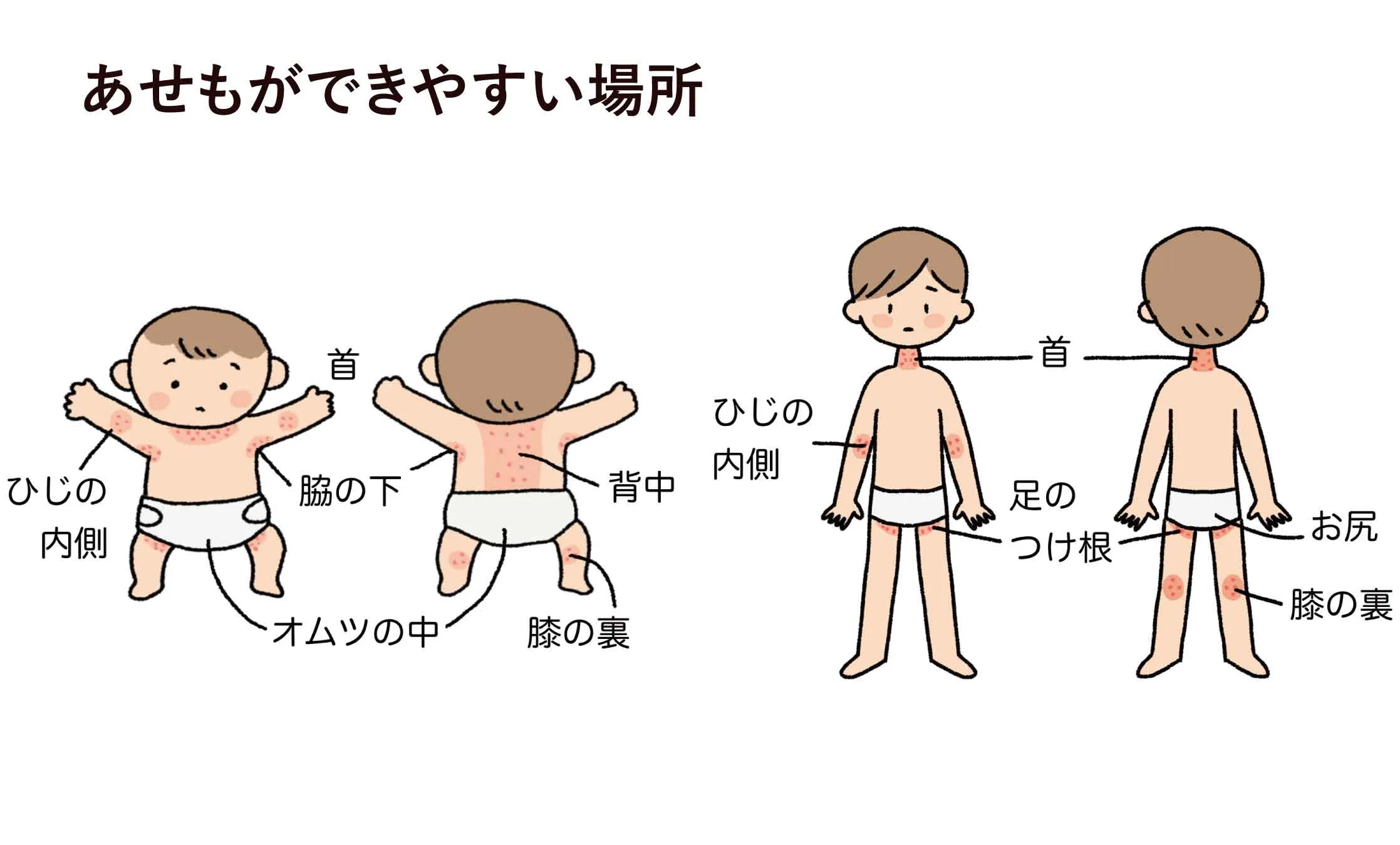 赤ちゃん（左）と子供（右）の体に見られる、あせもができやすい部位を赤色で示した比較イラスト。