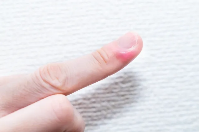 ひょう疽・爪囲炎の初期症状（膿がなく赤く腫れた状態）