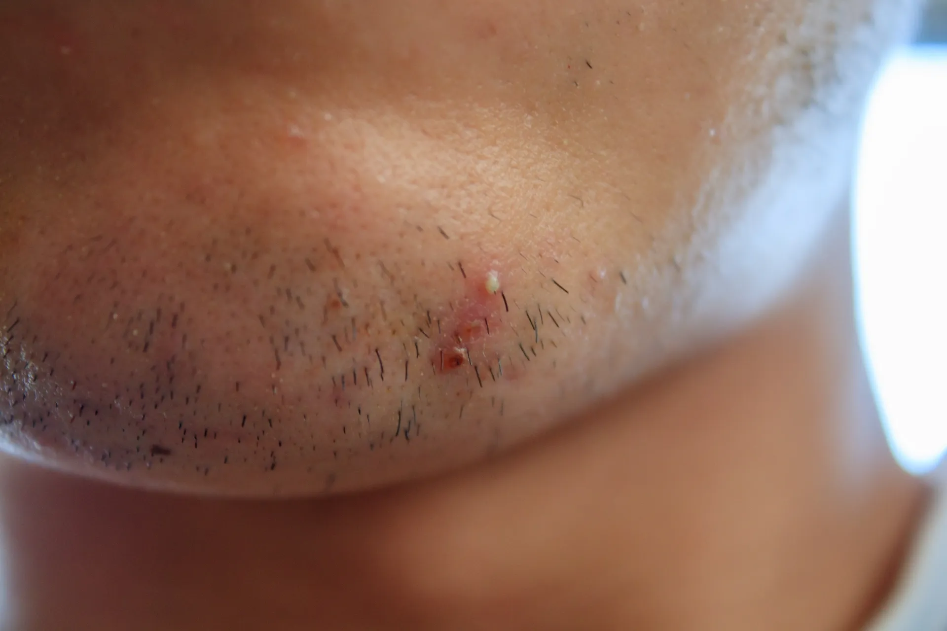 毛穴に一致した赤みと白い膿疱が見られる毛嚢炎の症状例