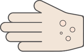 皮膚科診療案内の手にできものができているイラスト