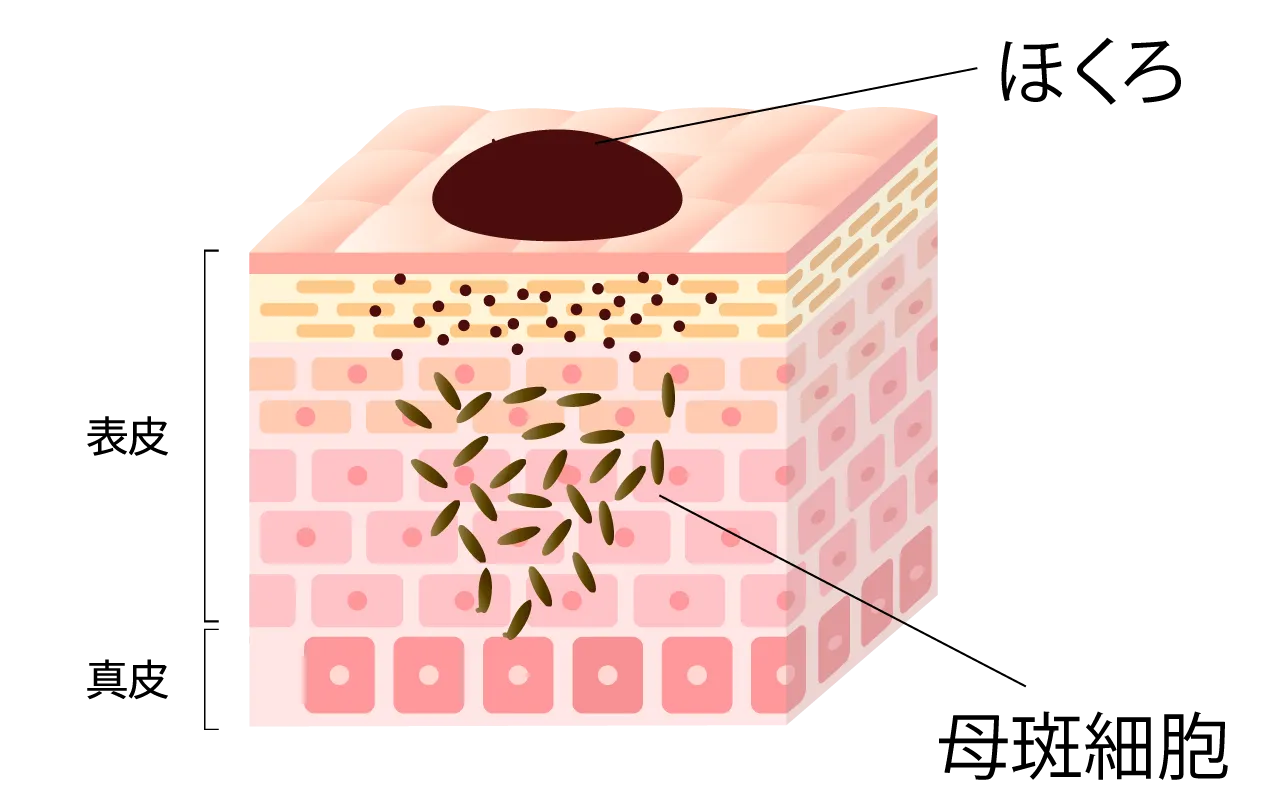 ほくろの断面構造のイラスト。皮膚の表面にある「ほくろ」から、表皮・真皮の内部に向かって「母斑細胞（ぼはんさいぼう）」が集まっている様子を示した図解。