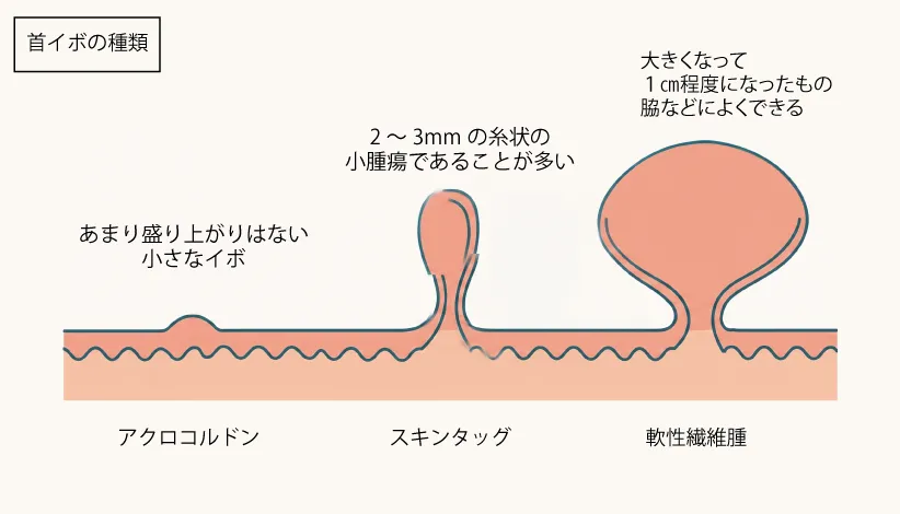 首イボ（スキンタッグ）の3つの形状を示す図解イラスト。左からアクロコルドン、スキンタッグ、軟性線維腫の育ち方を表現しています。
