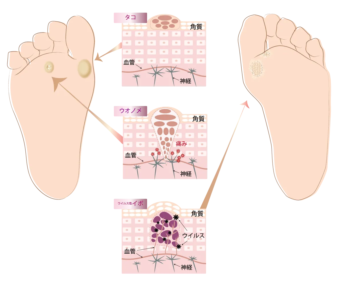 イボ（尋常性疣贅）・魚の目・タコの違いを説明した皮膚構造の比較図解イラスト