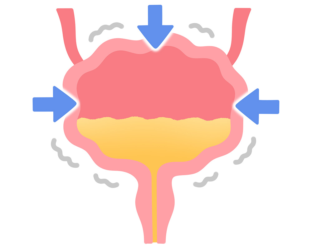 女性の頻尿の原因に多い過活動膀胱の症状がでている膀胱