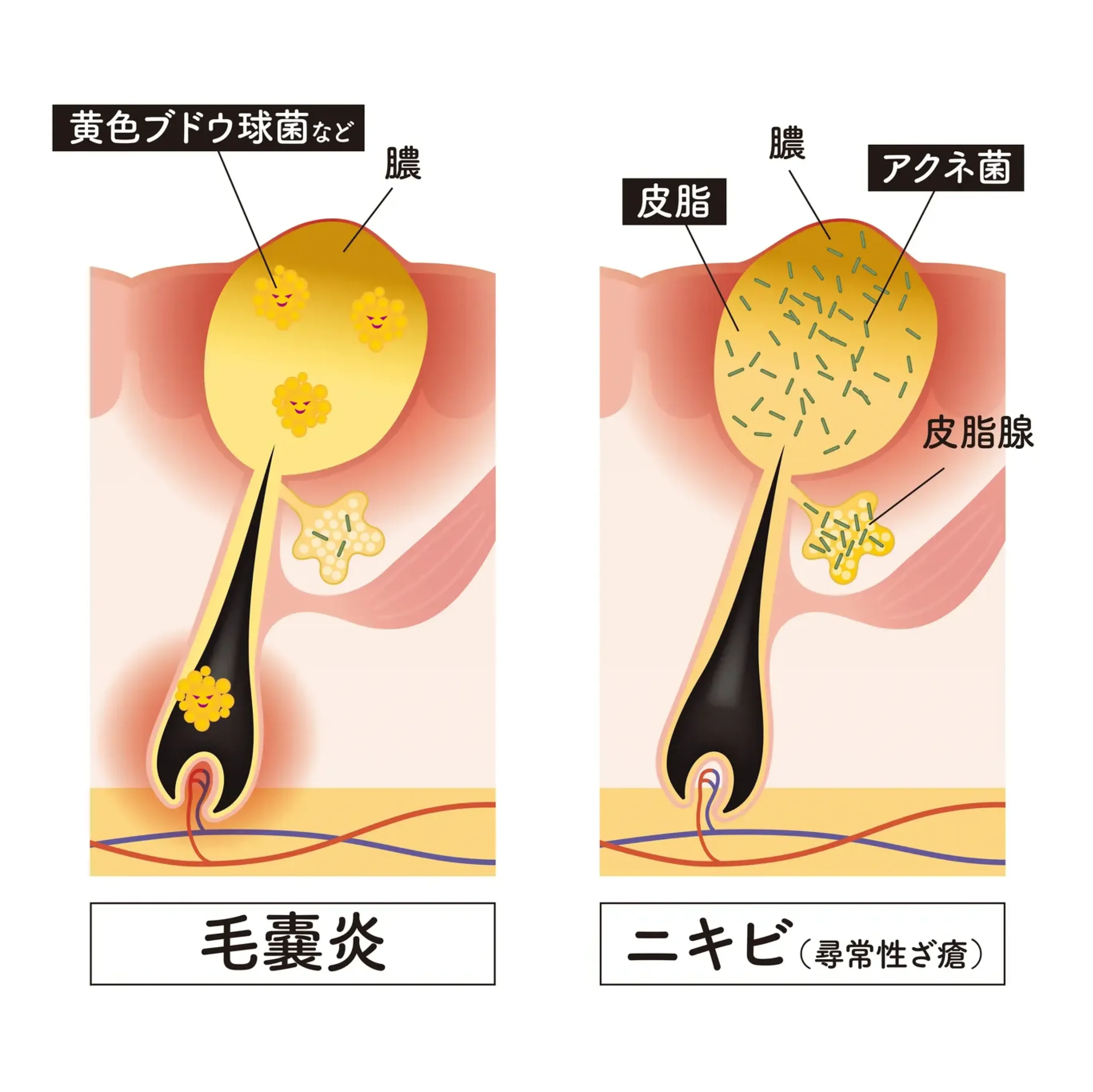 毛嚢炎（黄色ブドウ球菌）とニキビ（アクネ菌）の発生メカニズムと炎症の深さの違いを説明した図解イラスト。