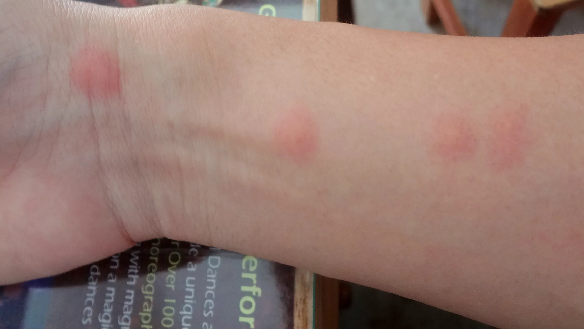 トコジラミ（ナンキンムシ）による腕の虫刺され症状例。赤いブツブツが集中して現れる。