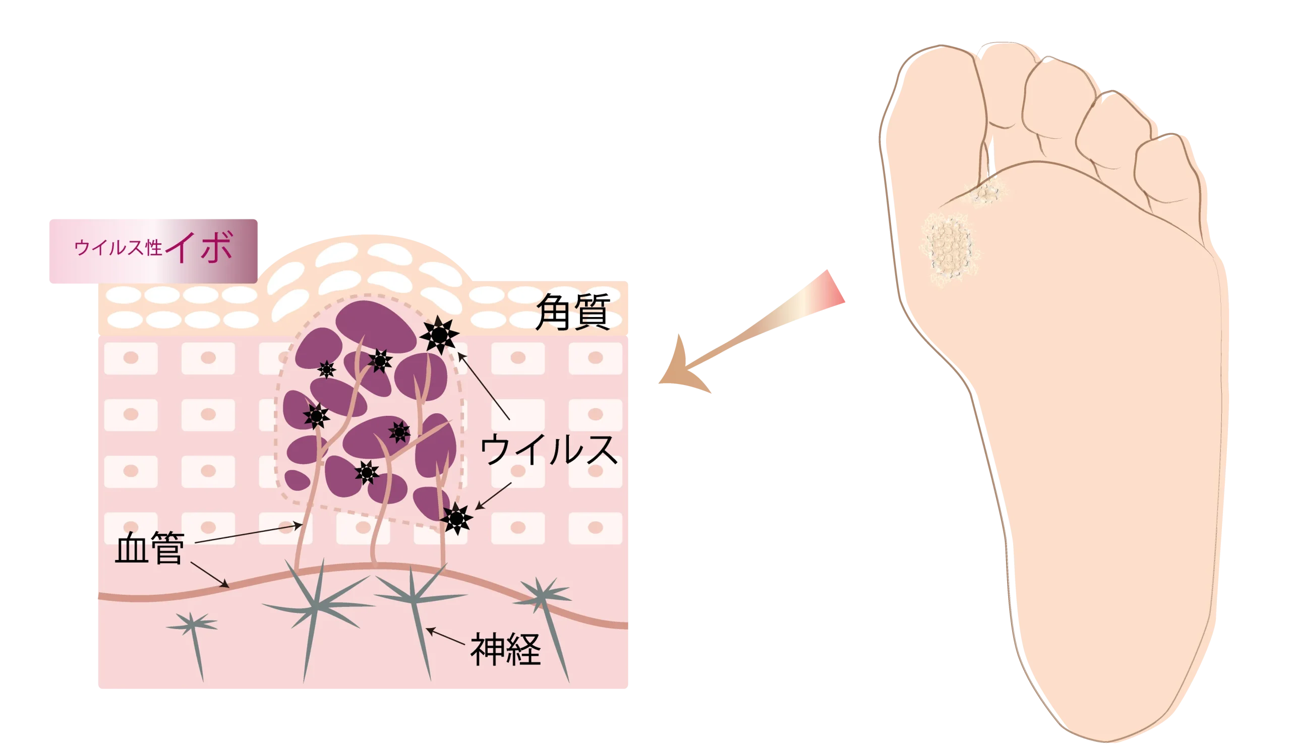 ウイルス性イボ(尋常性疣贅)ができる仕組みを説明した皮膚断面図と足の裏のイラスト