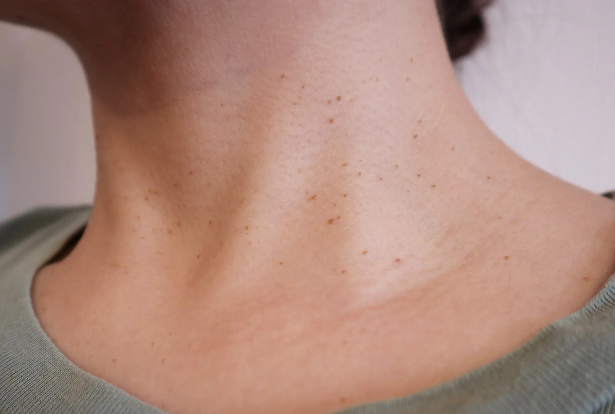 首周りに多発した首イボ（スキンタッグ）の症例写真。肌色から淡褐色の小さな突起が複数見られます。