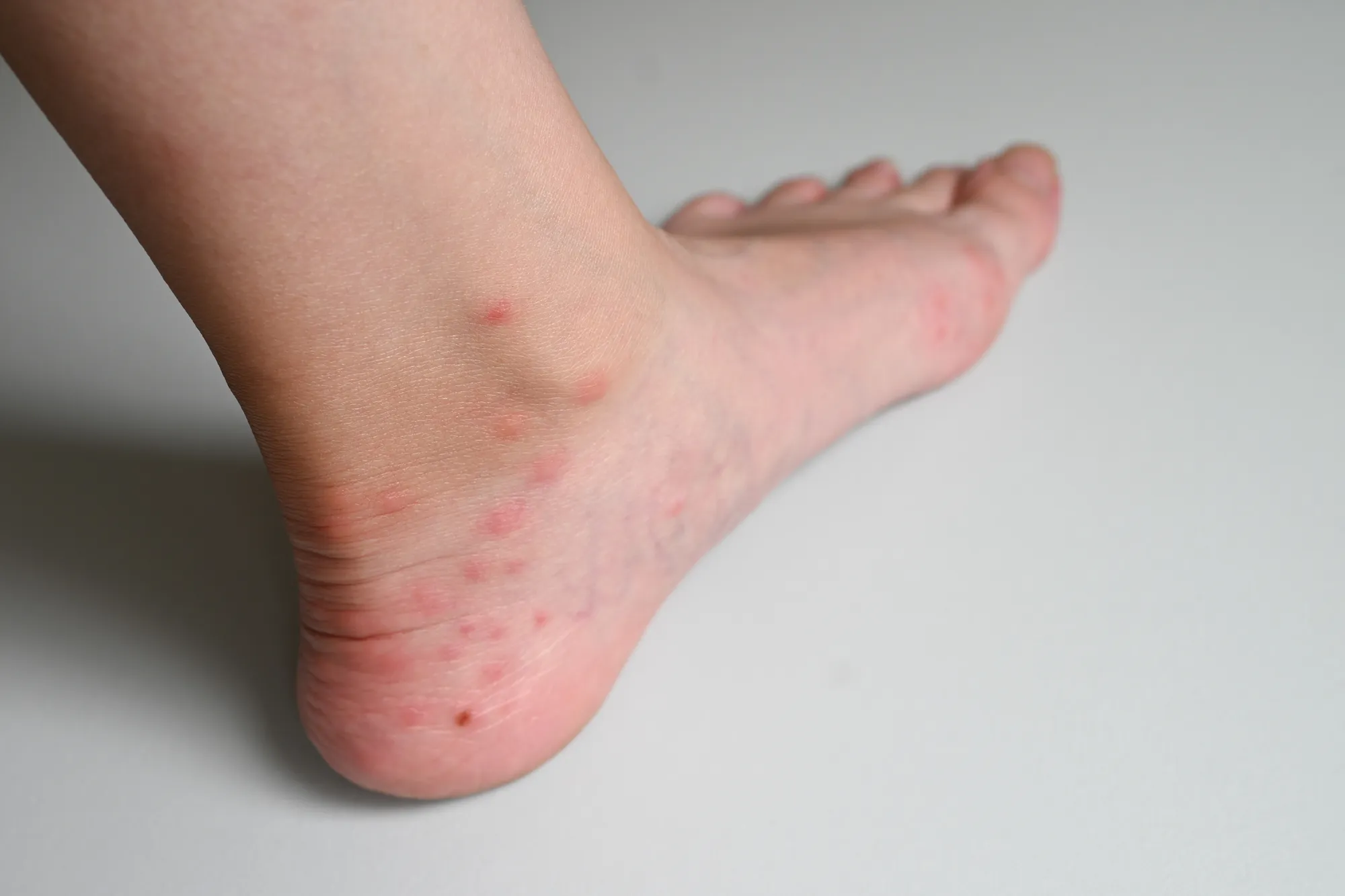 足首周辺に多数できた、赤い虫刺され（虫刺症）の症状例
